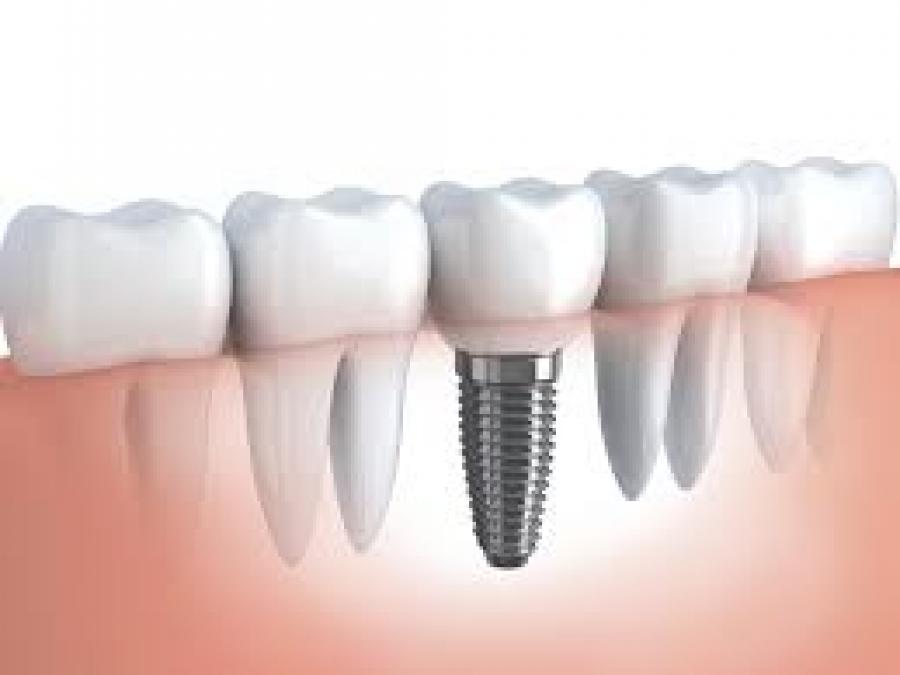 SUCCESS RATE INCREASES WHEN IMPLANT TREATMENT WİTH TECHNİQUE IS APPLİED
